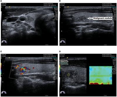 Idiopathic Hypoparathyroidism With Papillary Thyroid Carcinoma in a Young Male: A Rare Case Report